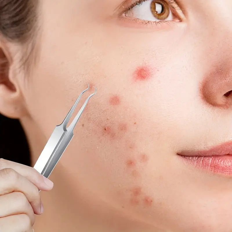 Kosmetologiniai įrankiai inkštirams šalinti