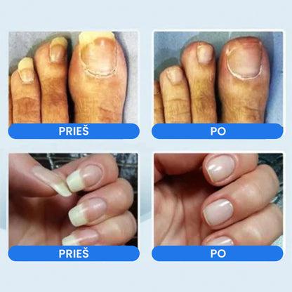 NailCutter™ - profesionalus nagų priežiūros rinkinys – naudojimo pavyzdys
