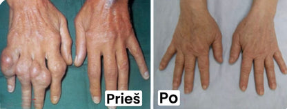 rankų išvaizdos palyginimas prieš ir po