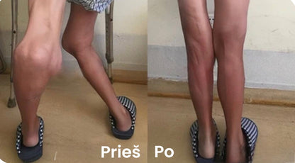 kojų išvaizdos palyginimas prieš ir po