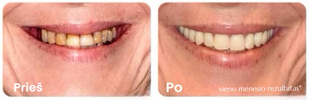 Dantų balinimo skystis Smile su 99,99% bakterijų naikinimu